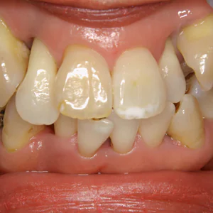 【軽度】抜歯して歯周病を治すのは簡単！でも、残していく技術は相当に難しい！
