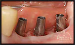 当院のインプラント完成実例（単冠編）