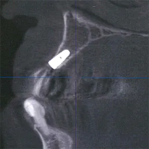 ope直後のインプラント(CT＝3次元レントゲンから診たインプラントの経過)