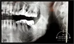 重度歯周病に対する骨造成手術（部分的重度）