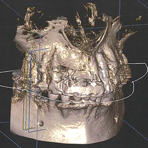 歯周病や歯根破折で酷く骨が無くなった後の同時にGBR+インプラント手術のCT画像