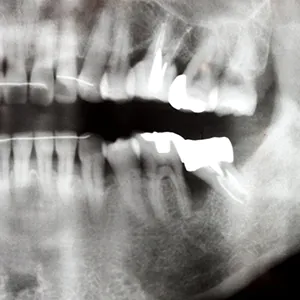 重度歯周病に対する骨造成手術（部分的重度）