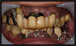 残せる歯は残し、必要最低限にインプラントを減らす