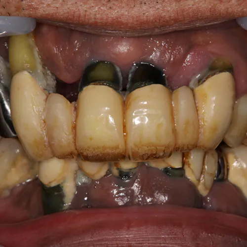 残せる歯は残し、必要最低限にインプラントを減らす