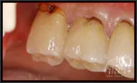 【過去を振り返る】奥歯の歯ぐきの腫れ（ハレ）について【分岐部病変】