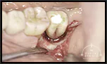 【過去を振り返る】1本の奥歯だけが重度の歯周病。しかし、ほとんど骨が無くても、 骨再生をさせて噛めるまでに回復する(部分的重度歯周病)