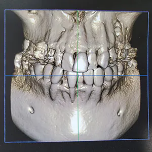 CTから視る!!非抜歯矯正と「中等度の歯周病」「神経治療」「変色している緑色の乳歯」