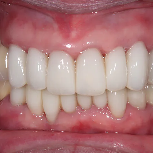 「歯を残すという治療®・技術」を施すと、歯ぐきは何歳まで回復するのか?81歳 女性