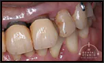 【中度】このままでは、前歯が3本ともが、歯茎が下がって歯が抜け落ちそう…歯周病で！