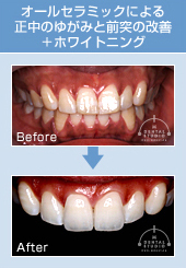 オーラルセラミックによる正中のゆがみと前突の改善+ホワイトニング