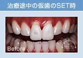 治療途中の仮歯のSET時