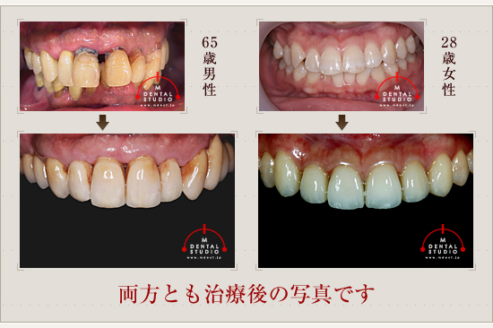 両方とも治療後の写真です