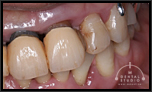 このままでは、前歯が3本ともが、歯茎が下がって歯が抜け落ちそう…歯周病で！【49歳・女性】