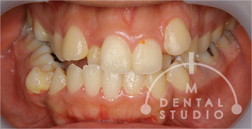 激しい歯列(歯並び)の乱れと、酷い顎関節症、上下顎(アゴ)のずれ！顎変形症を『骨切りの外科手術なし』で治したケース【20歳・女性】