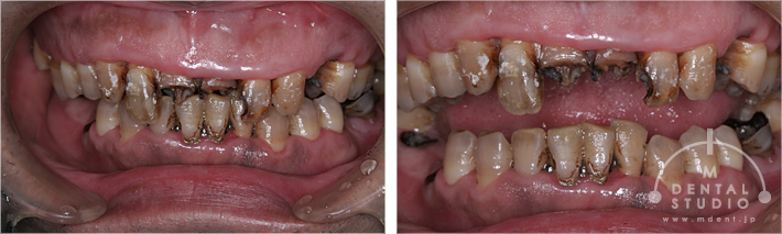 あごの骨折、それによるアゴのズレさらに歯周病ひどい虫歯による歯の崩壊