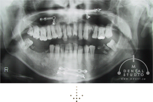 あごの骨折、それによるアゴのズレさらに歯周病ひどい虫歯による歯の崩壊
