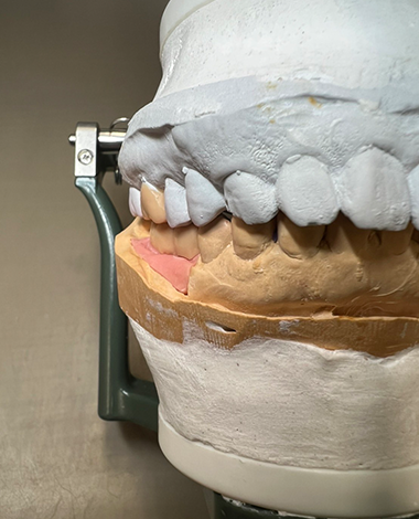 まさかこの症状も噛み合わせから来ていた!?だから、慎重に慎重に