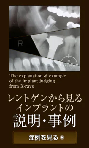 レントゲンからみるインプラントの説明・事例