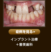 インプラント治療+審美歯科