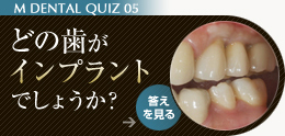 どの歯がインプラントでしょうか？