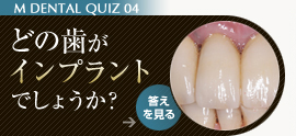 どの歯がインプラントでしょうか？