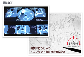 確実に行なうためのインプラント術前の治療設計図