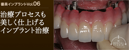審美インプラントVol.06「治療期間が長くなるなら、上の受け口になっている歯を抜いてください。」