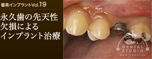 審美インプラントVol.19「永久歯の先天性欠損によるインプラント技術」