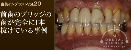 審美インプラントVol.20「前歯のブリッジの歯が完全に1本抜けている事例」