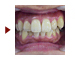 歯を抜かない矯正治療（26歳女性）