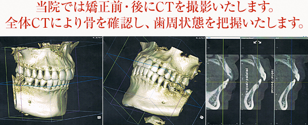 当院では矯正前・後にCTを撮影いたします。全体CTにより骨を確認し、歯周状態を把握いたします。