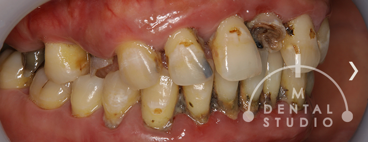 【超・重症歯周病】ボロボロ・グラグラ・ガタガタな虫歯と歯周病でも改善!!（40歳女性）