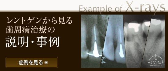 レントゲンから見る歯周病治療の説明・事例