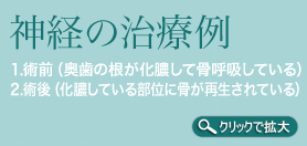 神経の治療例