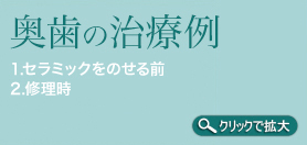 奥歯の治療例