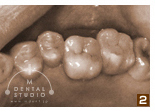 奥歯の治療例