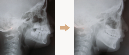 床矯正の治療例　