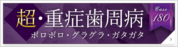 超・重症歯周病　ボロボロ・グラグラ・ガタガタ