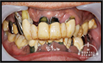 治療実績集 No.177 残せる歯は残し、必要最低限にインプラントを減らす【50代・男性】