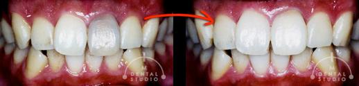 内部ホワイトニング使用左・前歯の変色に対し、交換薬剤を含め3回しました。