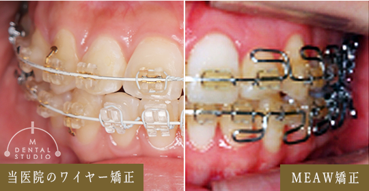 当院が「MEAW矯正」を採用しない理由と特徴の違い
